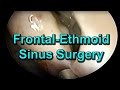 How is Functional Endoscopic Sinus Surgery Performed? Frontal ethmoid sinusitis, pain and headache.