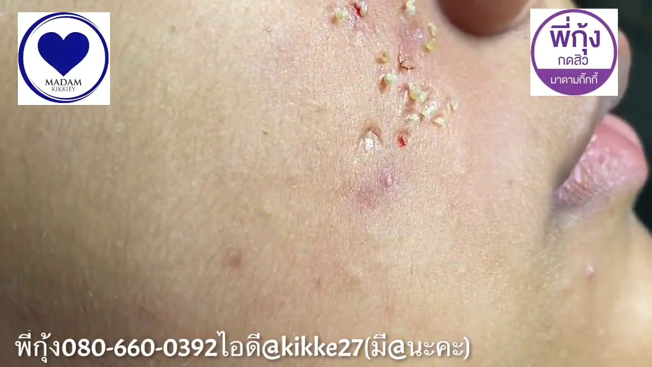 How to removal cystic acne Blackheads and whiteheads acne treatment