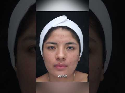 ¡Stop acné! 3 alimentos que debes evitar  #acne