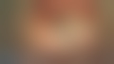 Right total ossicular chain reconstruction with TM grafting for incus erosion Dr Robert Vincent