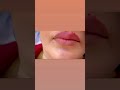 لاحض الشفه بعد حقن الفلر