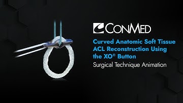 Curved Anatomic Soft Tissue ACL Reconstruction Using XO Button® - CONMED Animation