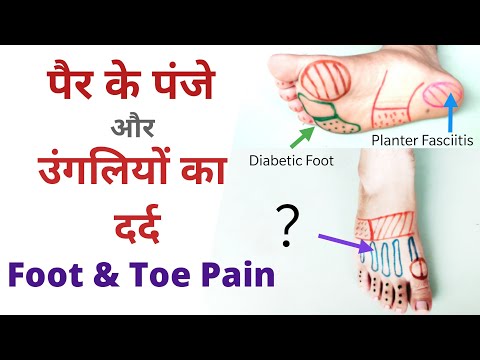 पैर के पंजे और पैर की उंगलियों का दर्द | Foot and toe pain |Dr. vivek Gaur Physiotherapist