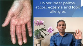 Hyperlinear palms, eczema and food allergies