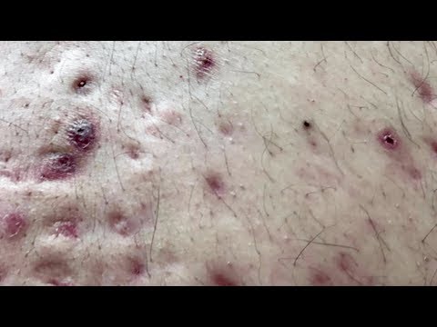 How To Remove Blackheads And Whiteheads On Back ✦ Dr Laelia ✦