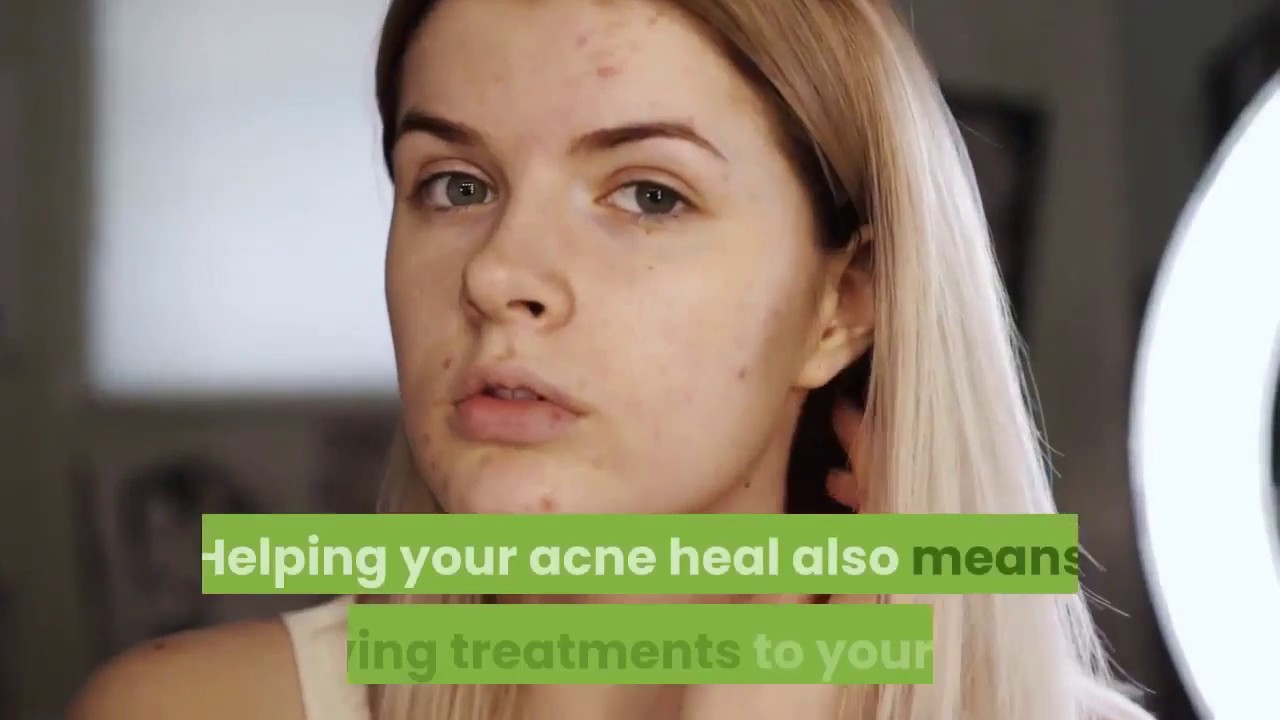 ACNE (Natural Treatment) - YouTube