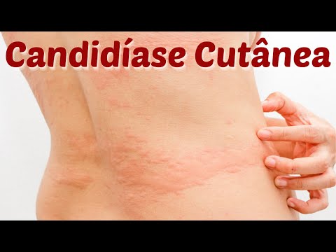 Vídeo: Candidíase Cutânea - Tratamento, Candidíase Cutânea Facial, Candidíase Cutânea Em Crianças