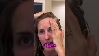 Endometrial Ablation at 30 #livingmybestlife