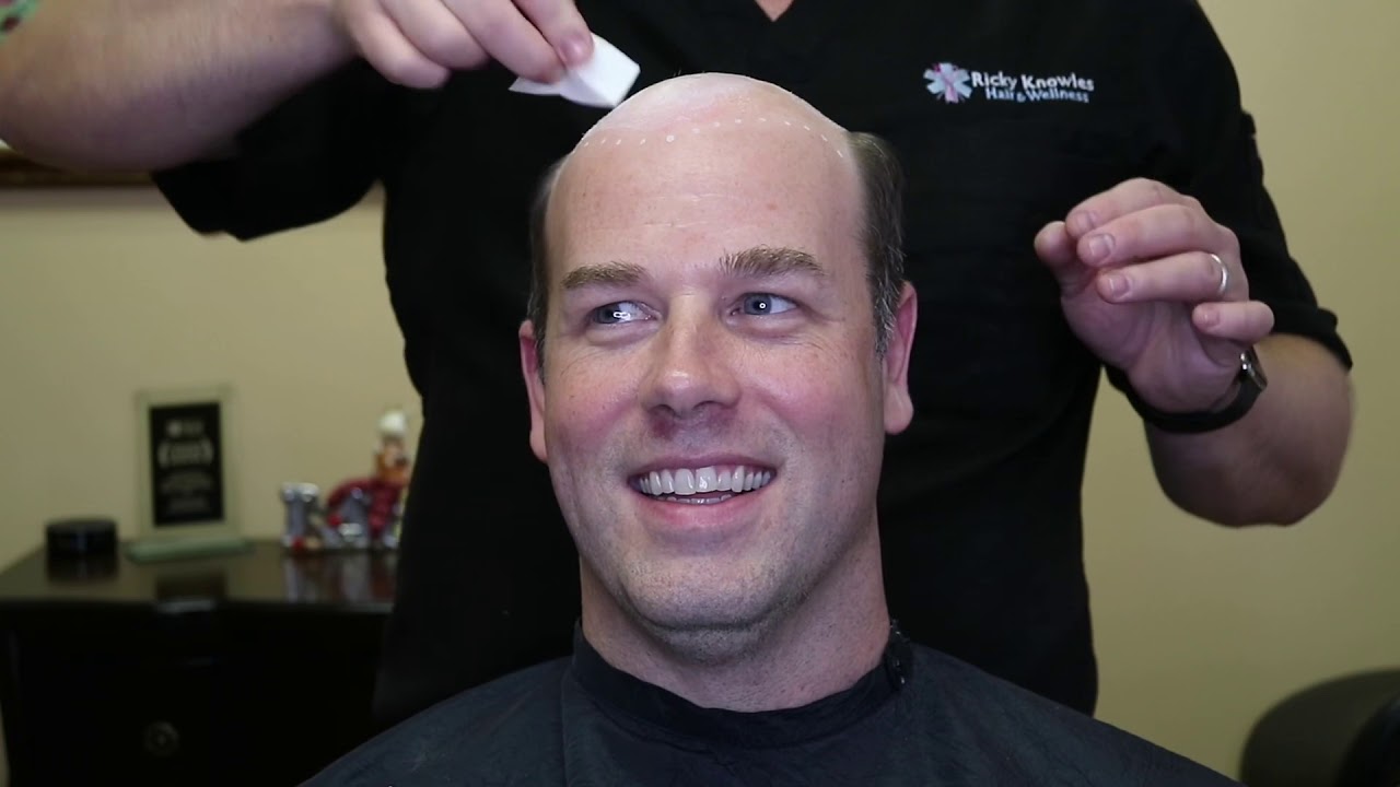 Hair replacement - YouTube