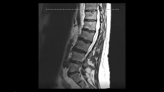 Featured case: MAS Midline and bilateral TLX20 with Dr. Jethwa