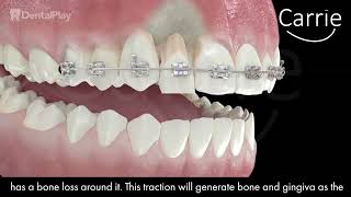 Orthodontic Extrusion  (Orthodontic Procedures)