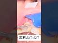 歯石ボロボロ取り除いていきます#セラミック #歯石 #歯周病