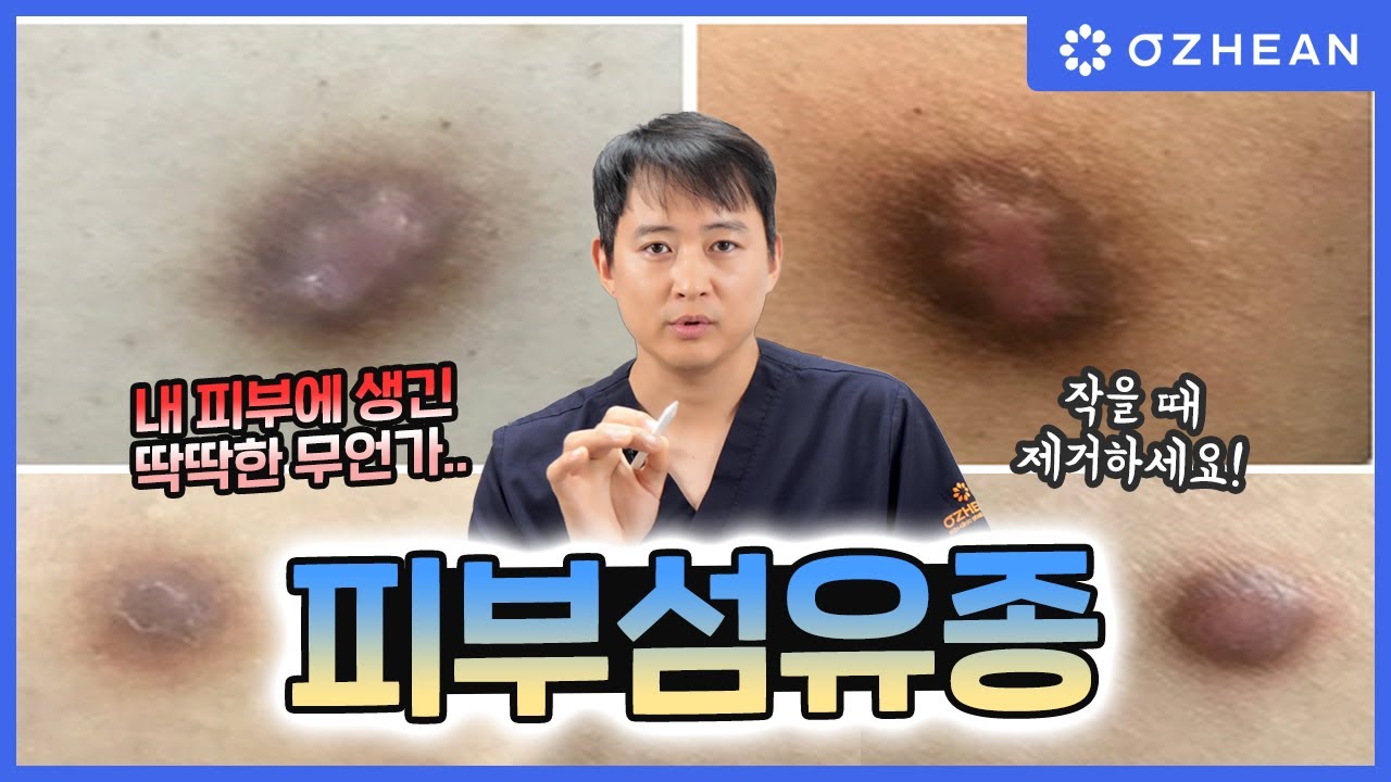 혹처럼 뭉쳐있는 피부 섬유종! 내 피부 안에 뭔가 만져진다면? - YouTube