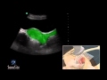 3D How To: Female Pelvis Ultrasound Exam - SonoSite Ultrasound