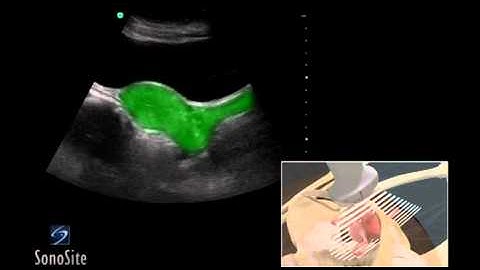 How To: Female Pelvis Ultrasound Exam 3D Video