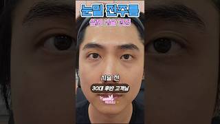 순식간에 사라진 눈밑 잔주름 | 리투오 시술 전과정 &amp; 다음날 눈밑 영상 공개 #shorts