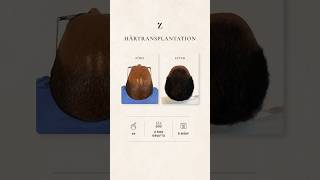 TP Resultat 6 Månader - Mohamed #hårtransplantation #resultat