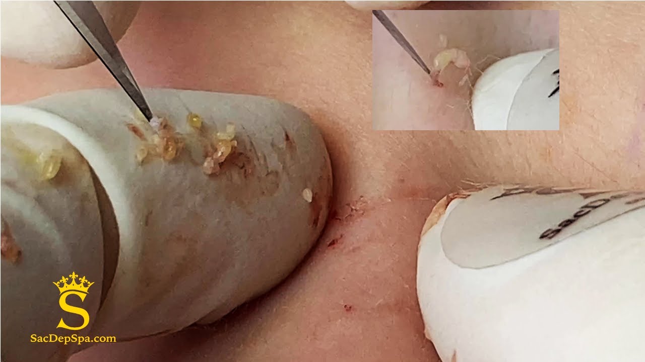 Removing Acne Under Skin For Girl | Loại Bỏ Mụn Ẩn Cho Bạn Gái - SacDepspa#124
