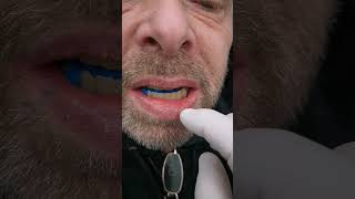 Ошибки при определения прикуса. Зубной техник в Нидерландах