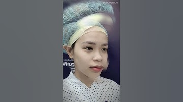 Nâng mũi cấu trúc 3D - Mũi cao thanh thoát chuẩn tỉ lệ vàng