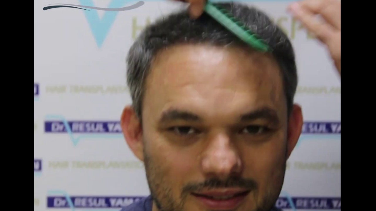 Trasplante Capilar - Dr. Resul Yaman - YouTube
