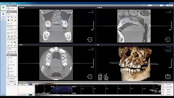 How to Configure Default Window Levels and 3D Opacity Xelis
