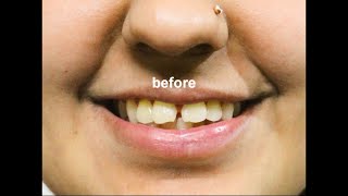 Smile makeover for Teeth Gaps by  Cosmetic Dentist Dr Trivikram