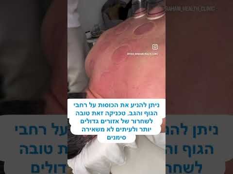הסבר קצר על טיפול בכוסות רוח עם יוסי אברהם