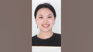 Khay niềng răng trong suốt niềng cắn hở có tốt không?| Nha Khoa Elite