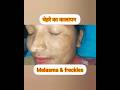 चेहरे का कालापन और इलाज #melasma #pigmentation #shorts #shortsfeed #shortsvideo #ytshorts #skincare