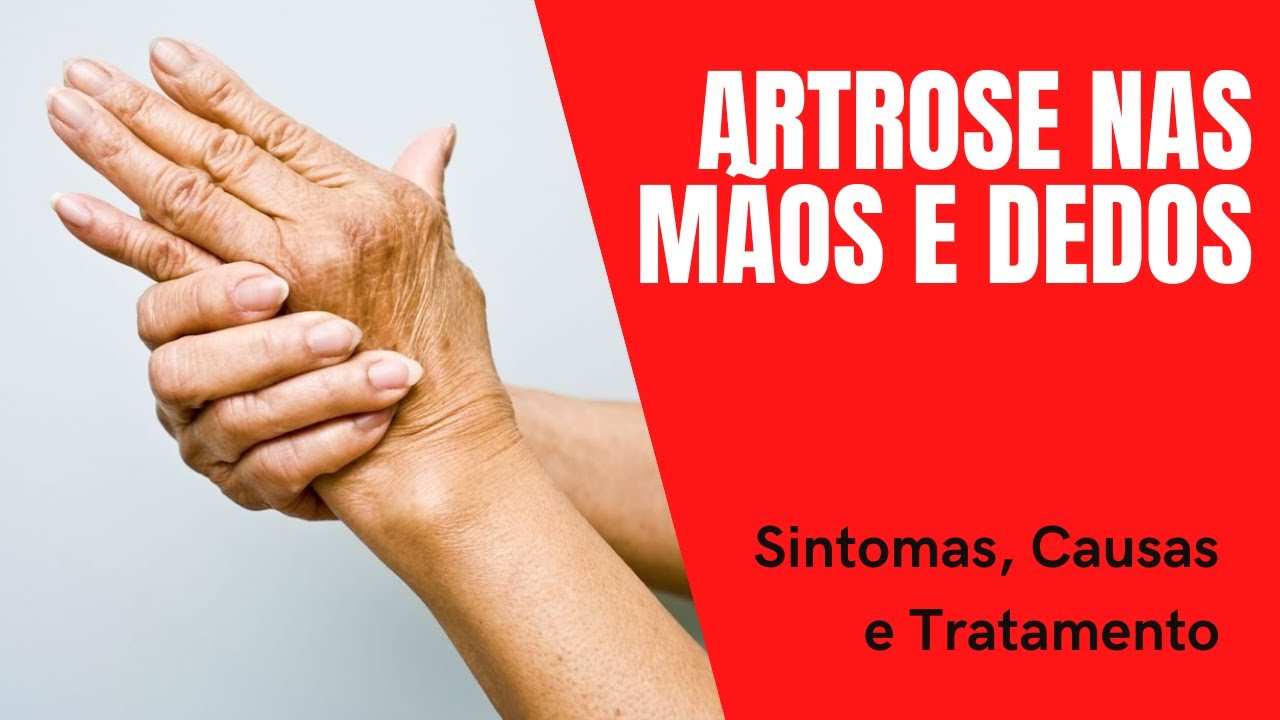 Artrose nas Mãos e Dedos Sintomas Causas e Tratamento YouTube Artrose nas Mãos e Dedos Sintomas Causas e Tratamento YouTube