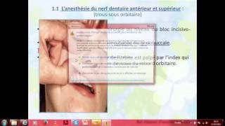 Anesthésie en Parodontologie