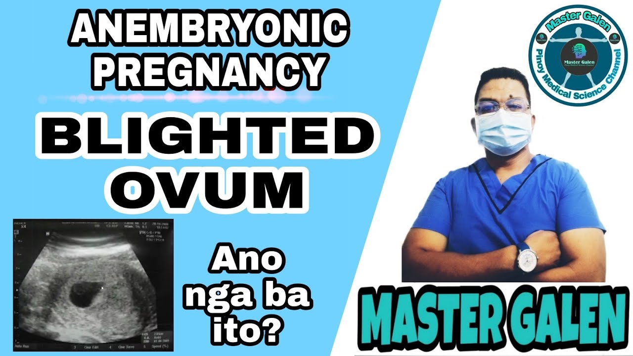 BLIGHTED OVUM o ang tinatawag na ANEMBRYONIC PREGNANCY. Ano nga ba ito.