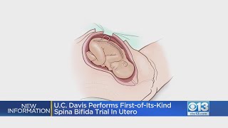Can you cure Spina Bifida before birth