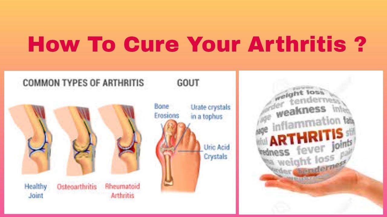 How To Cure Arthritis Types Symptoms Natural Treatment Youtube