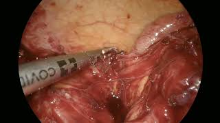 Severe Appendicular Abscess Surgery | Laparoscopy in a Difficult Case | Dr Nattapon Passawart