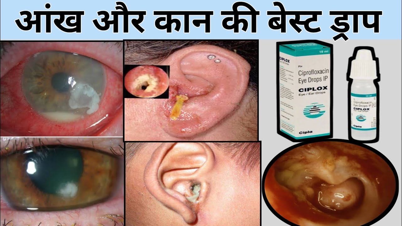 ciplox eye drops ciplox eye ear drops ciplox eye/ear drops