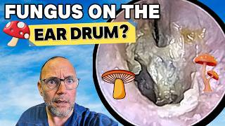 FUNGUS on the EAR DRUM! Episode 614