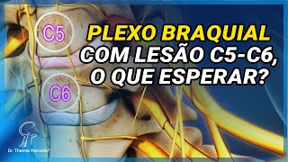 Lesão do Plexo Braquial C5-C6, O que esperar? Lesão do Plexo Braquial C5-C6, O que esperar?