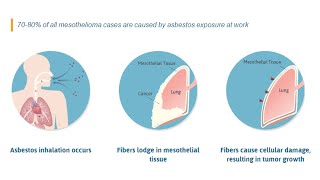 What Mesothelioma Is