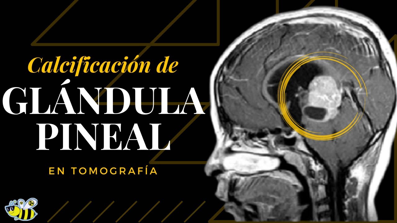 Calcificación de glándula pineal en tomografía