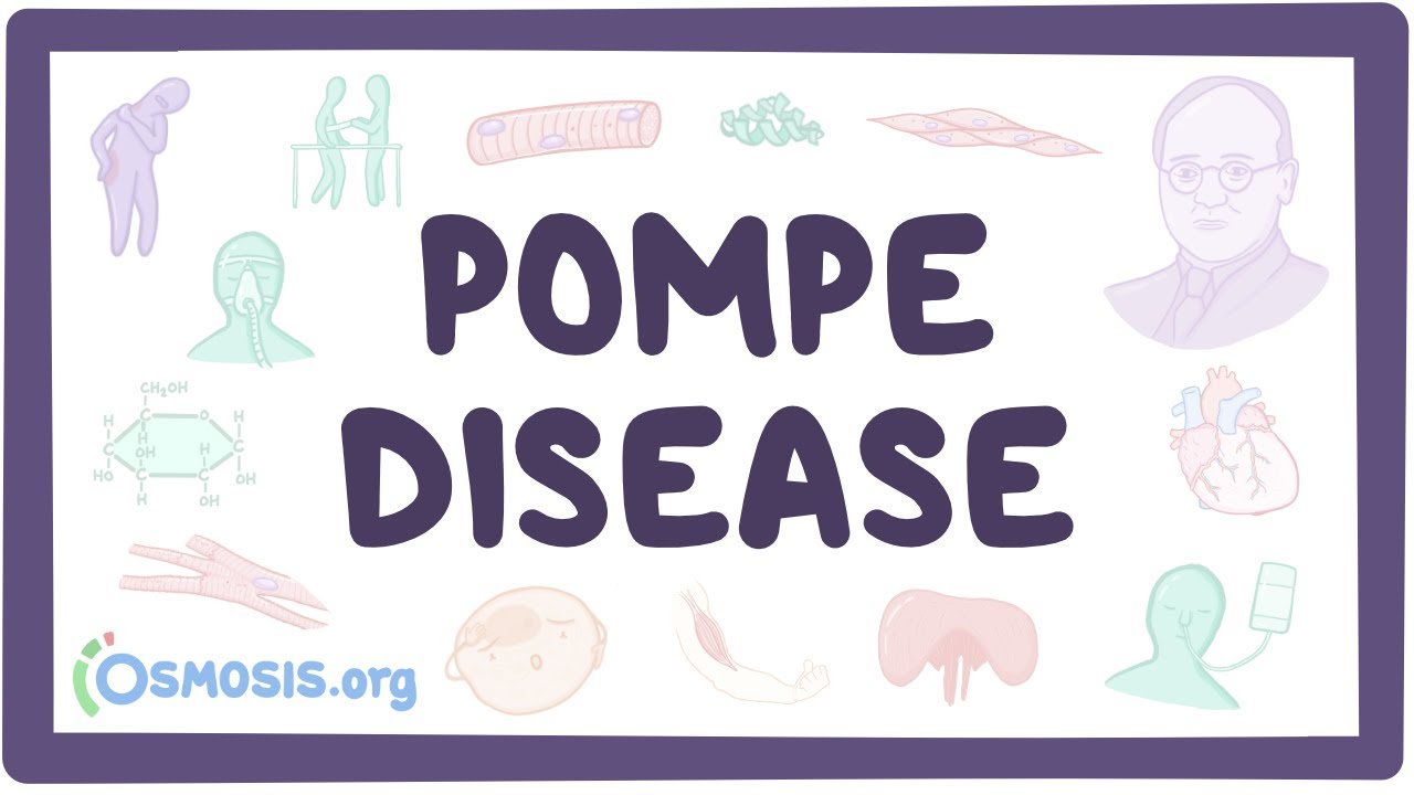 Download Pompe disease - causes, symptoms, diagnosis, treatment, pathology
