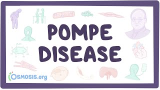 Pompe disease - causes, symptoms, diagnosis, treatment, pathology