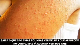 Das causa bolhas nas o que pernas fotos grandes