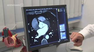 Herz-CT: So funktioniert die Auswertung (arztwissen.tv / Herz & Kreislauf)
