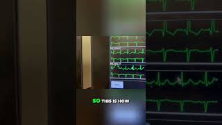 Color Coding Leads for Monitor Techs #monitortech #ekgtech #nursingstudent #ekginterpretation