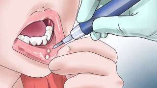 Labial tratamiento de herpes simple