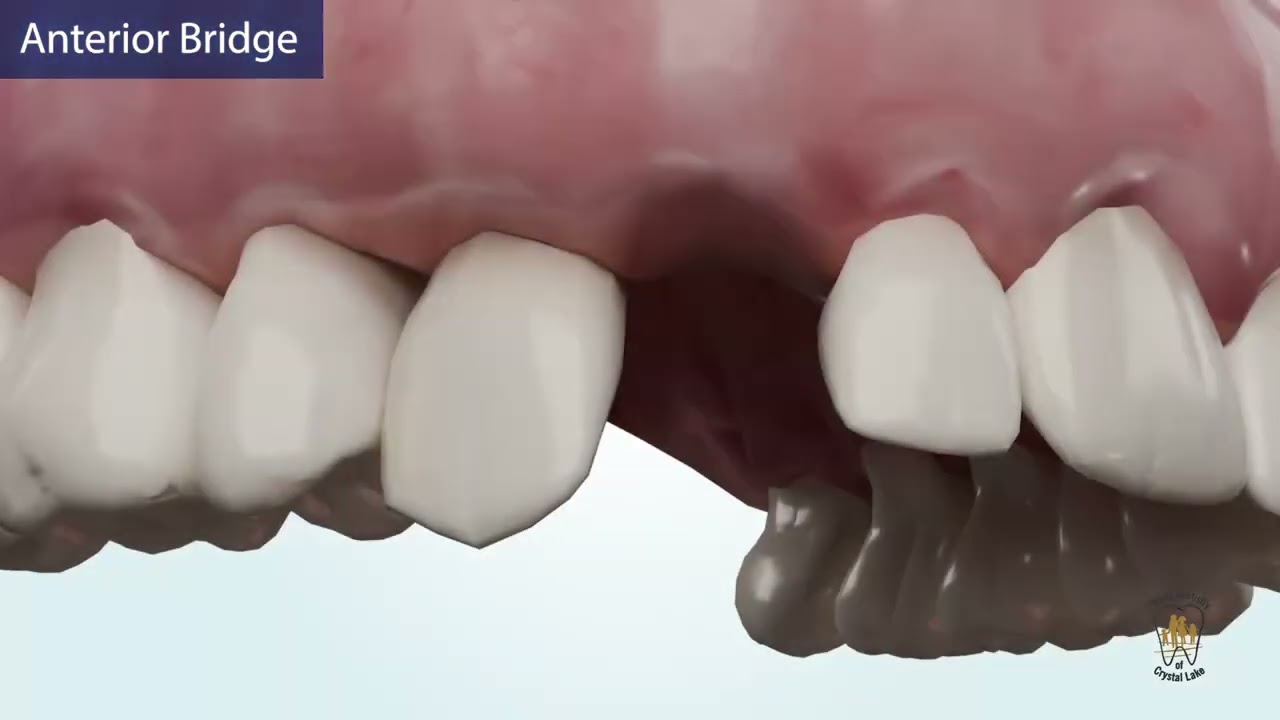 How to Replace Missing Teeth Naturally