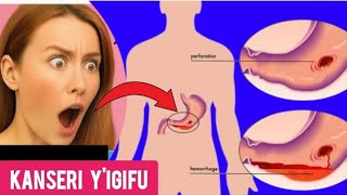 Urwaye Kanseri Yigifu Niba Ufite Ibi Bimenyetso 7