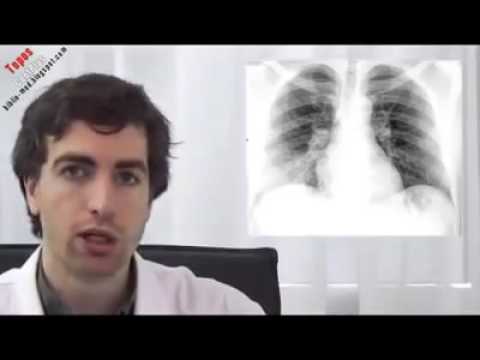lifebuoy Radio pulmonaire